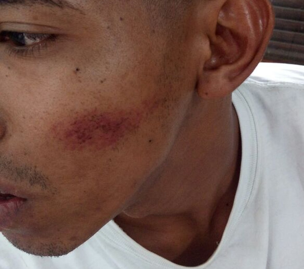 Venezuelano ficou com hematomas no rosto, braço e perna (Foto: Marcelo Marques/G1 RR)