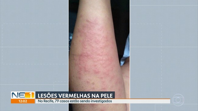 Prefeituras investigam manchas na pele que causam coceiras