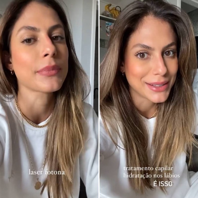 Mariely faz harmonização facial. Veja fotos e saiba valor