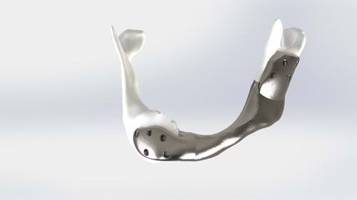 Mandíbula de titânio impressa em 3D é aplicada com sucesso pela 1ª vez (Foto: Instituto do Câncer Holandês)