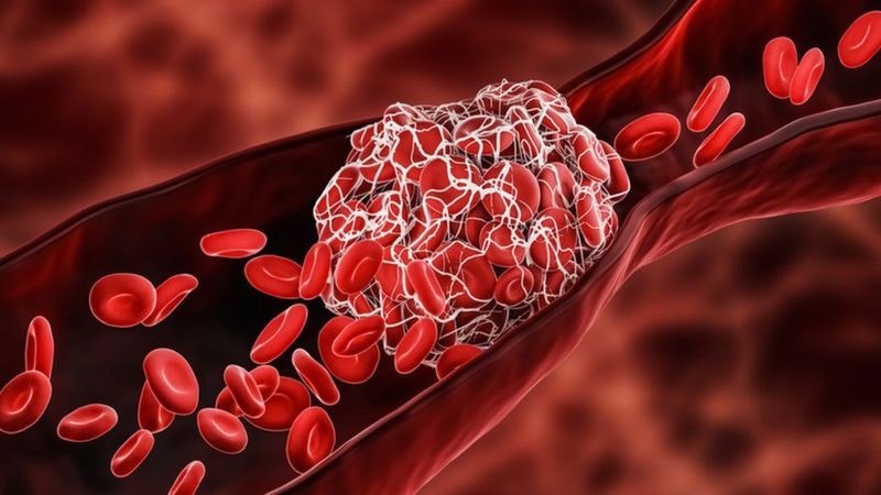 O trombo (ao centro) é uma massa de células e fibras que pode bloquear a passagem do sangue numa veia ou numa artéria (Foto: Getty Images via BBC News)