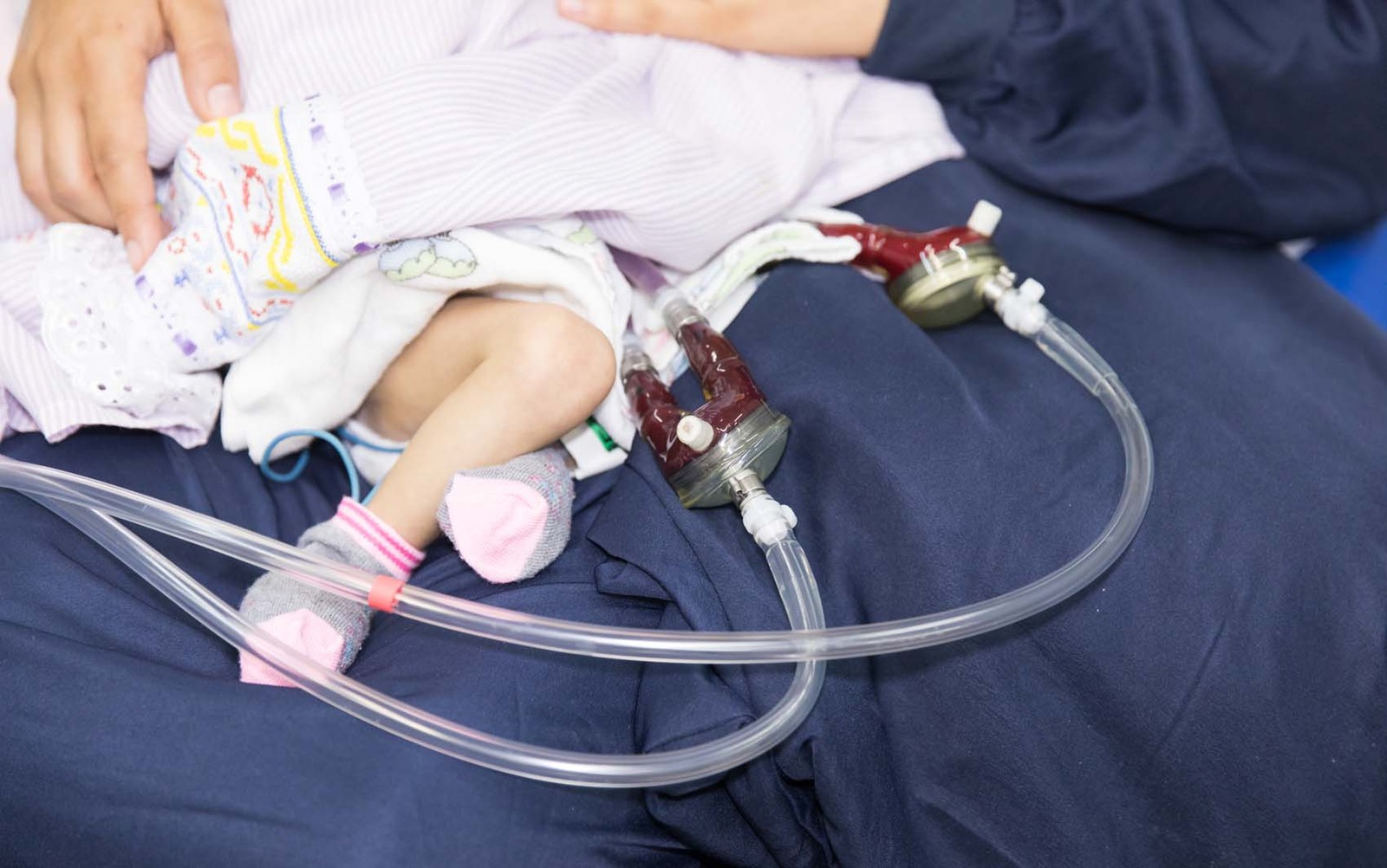 Menina recebe transplante de coração