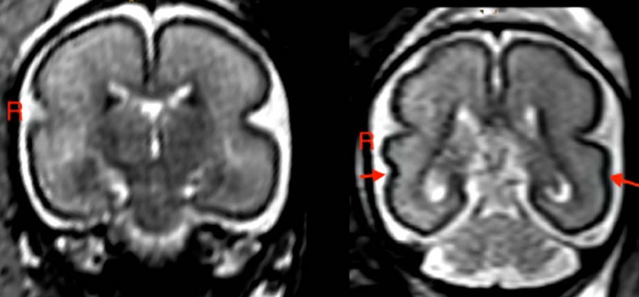 Esquerda: Cérebro fetal após exposição intrauterina ao álcool em feto entre 25 e 29 semanas de gestação. Direita: Cérebro de caso de controle saudável compatível em feto entre 25 e 28 semanas de gestação