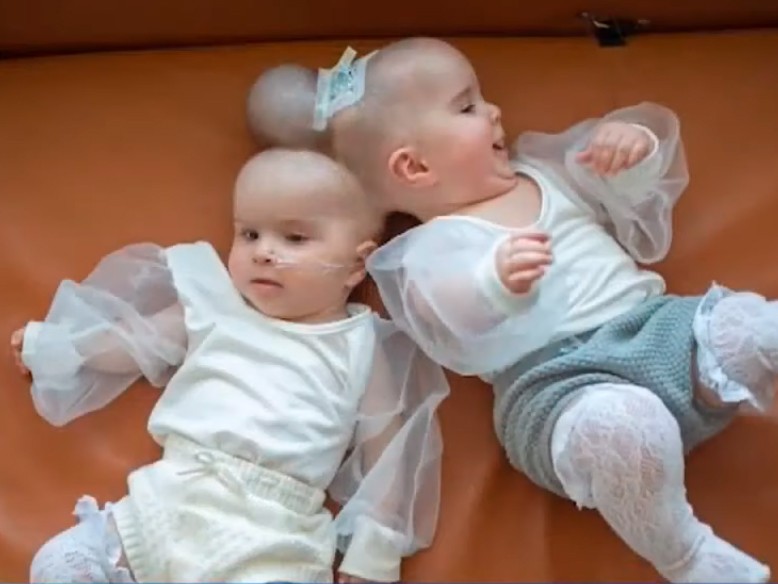 As gêmeas siamesas Abigail e Micaela Bachinsky (Foto: Reprodução/KCRA News)