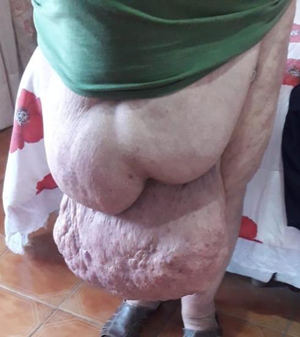 Idoso luta por cirurgia para remover hérnia gigante com mais de 30 kg