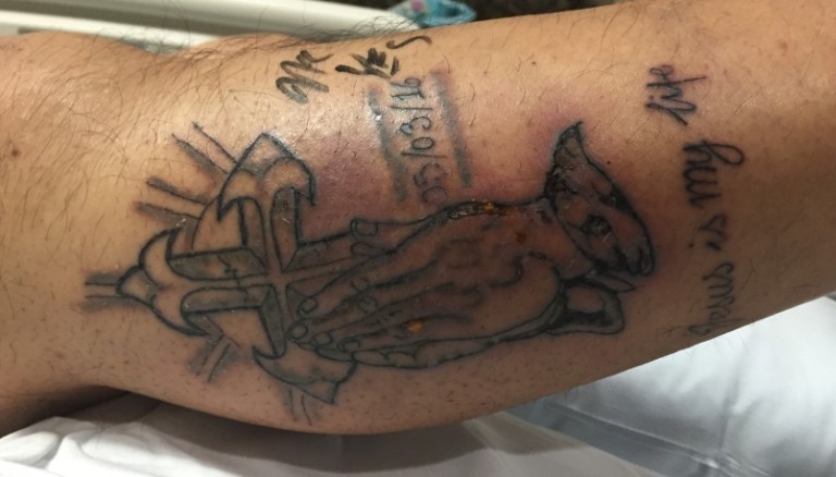 Infecção inicial na perna direita do paciente tatuado