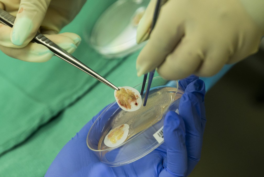 Foto mostra tecido do timo para transplante em um bebê em 16 de agosto de 2021 no hospital da Universidade Duke, no estado americano da Carolina do Norte. — Foto: Shawn Rocco/Duke Health via AP
