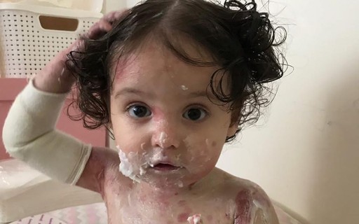 Bebe Com Doenca Rara Tem Pele Extremamente Fragil Que Se Enche De Bolhas Revista Crescer Saude
