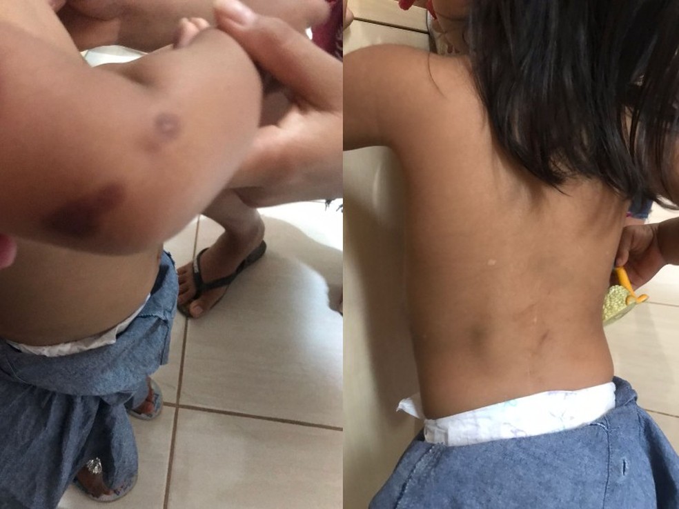 Lesões em criança de 1 ano no DF; suspeita é de maus-tratos pelo padrasto — Foto: Reprodução
