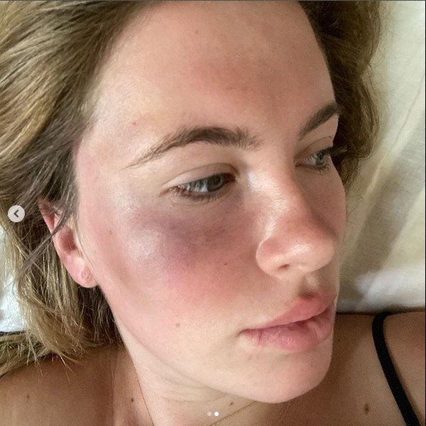 Ireland Baldwin com hematomas no rosto após ser vítima de uma agressão (Foto: Instagram)