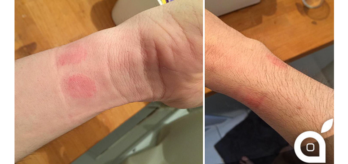 Relógio da Apple causou irritação na pele de usuário (Foto: Reprodução/iClarify)