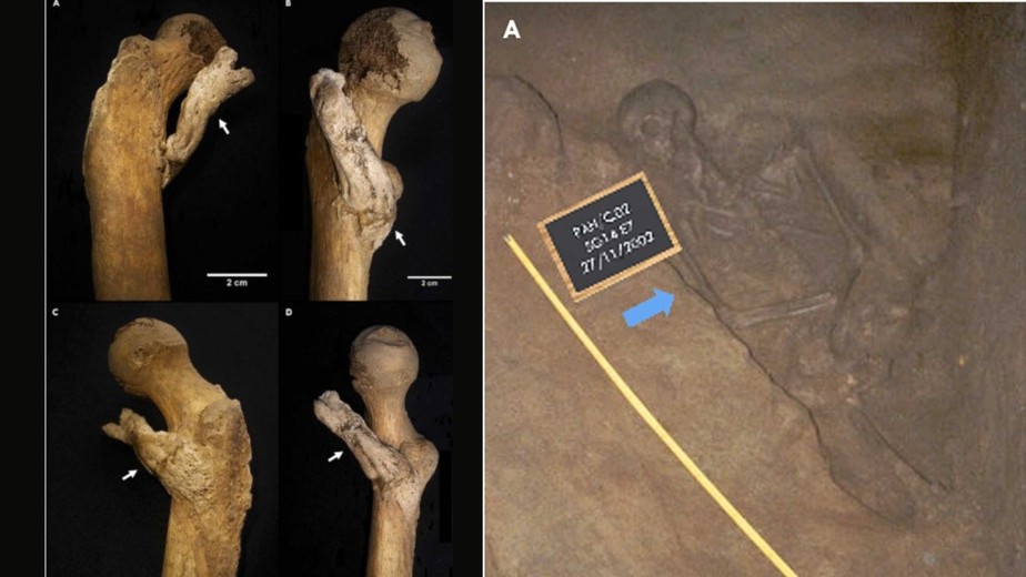 Crescimento ósseo raro foi identificado em restos de mulher que viveu entre os séculos 14 e 19
