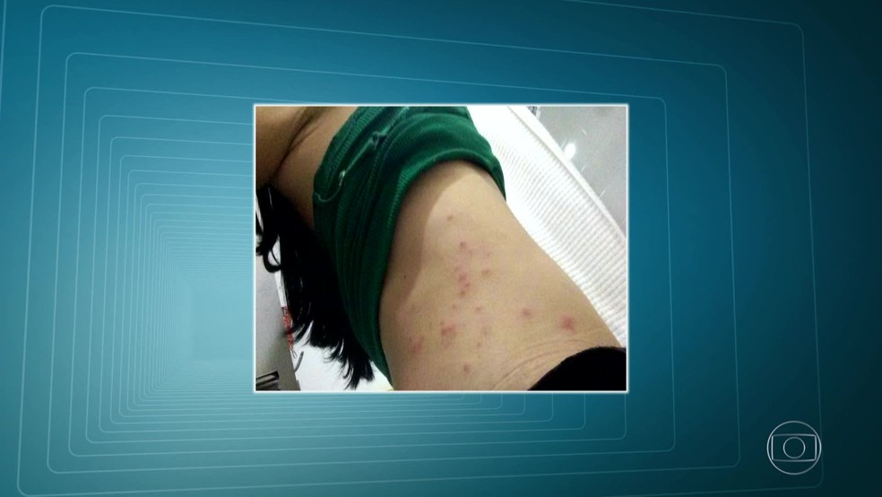 Pulgas causam ferimentos na pede de pacientes e funcionários no Hospital Federal dos Servidores do Estado. (Foto: Reprodução/ TV Globo)