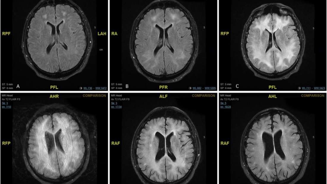 Da esquerda para a direita, Ã© possÃ­vel notar o aumento de uma regiÃ£o escura no cÃ©rebro com o passar dos meses (Foto: DivulgaÃ§Ã£o)