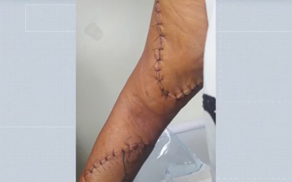 Mulher denuncia ex-companheiro após ser agredida com golpes de punhal em Candeal, no interior da Bahia — Foto: Reprodução/TV Subaé
