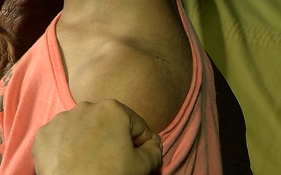 Mãe mostra hematoma no ombro; ela registrou ocorrência contra professora (Foto: TV Anhanguera/Reprodução)