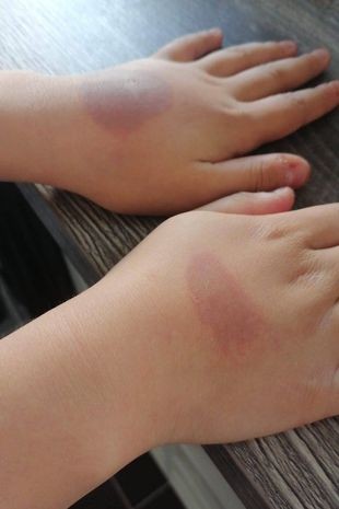Menina fica com graves queimaduras nas mãos após participar de desafio viral da internet (Foto: Reprodução/The Mirror)