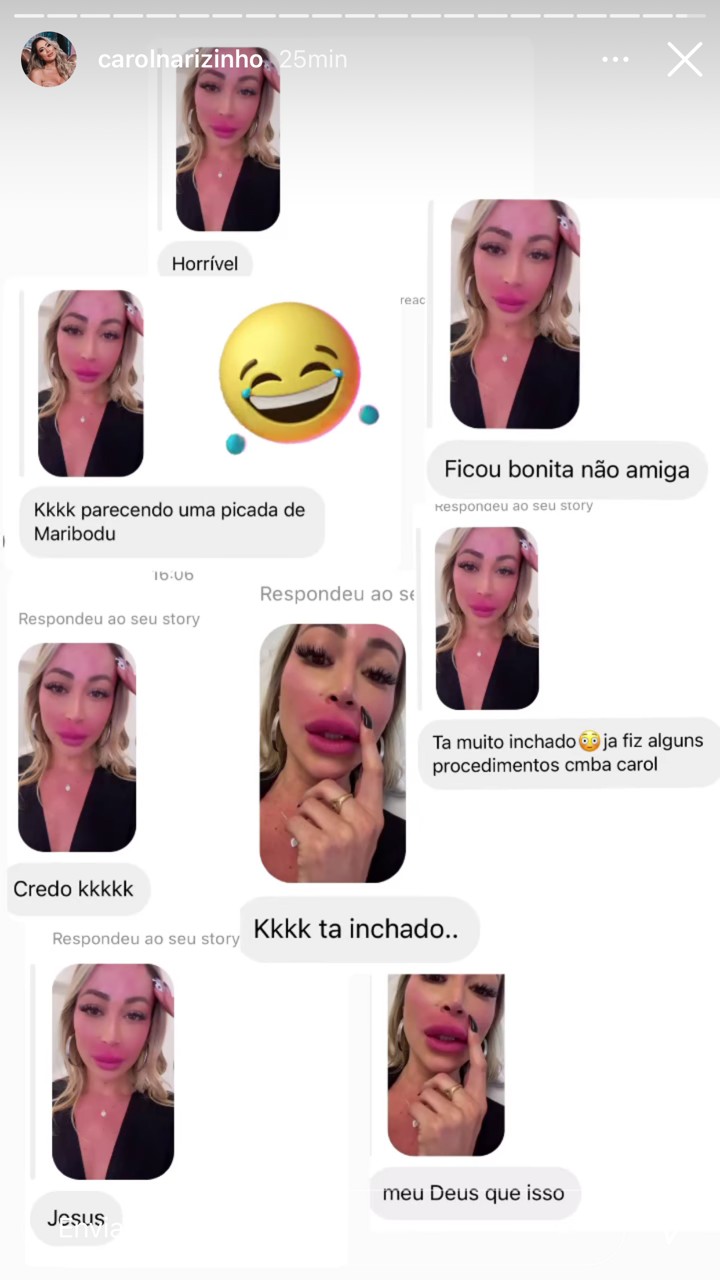Carol Narizinho mostra críticas dos internautas após procedimento na boca (Foto: Reprodução/Instagram)