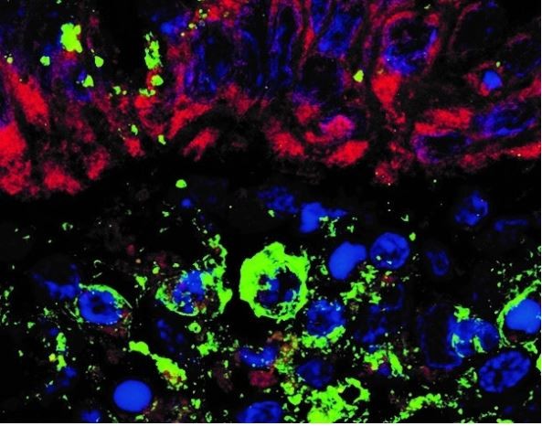 Biópsias intestinais infectadas com Sars-CoV-2 e coradas por imunofluorescência para a proteína humana ACE2 (vermelho) e para a proteína viral spike (verde). Os núcleos das células estão marcados em azul (Foto: Raquel Franco Leal/FCM-Unicamp)