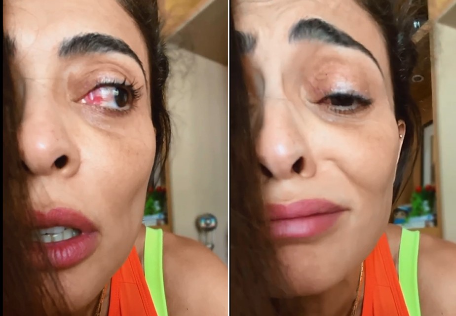 Juliana Paes lamenta alergia