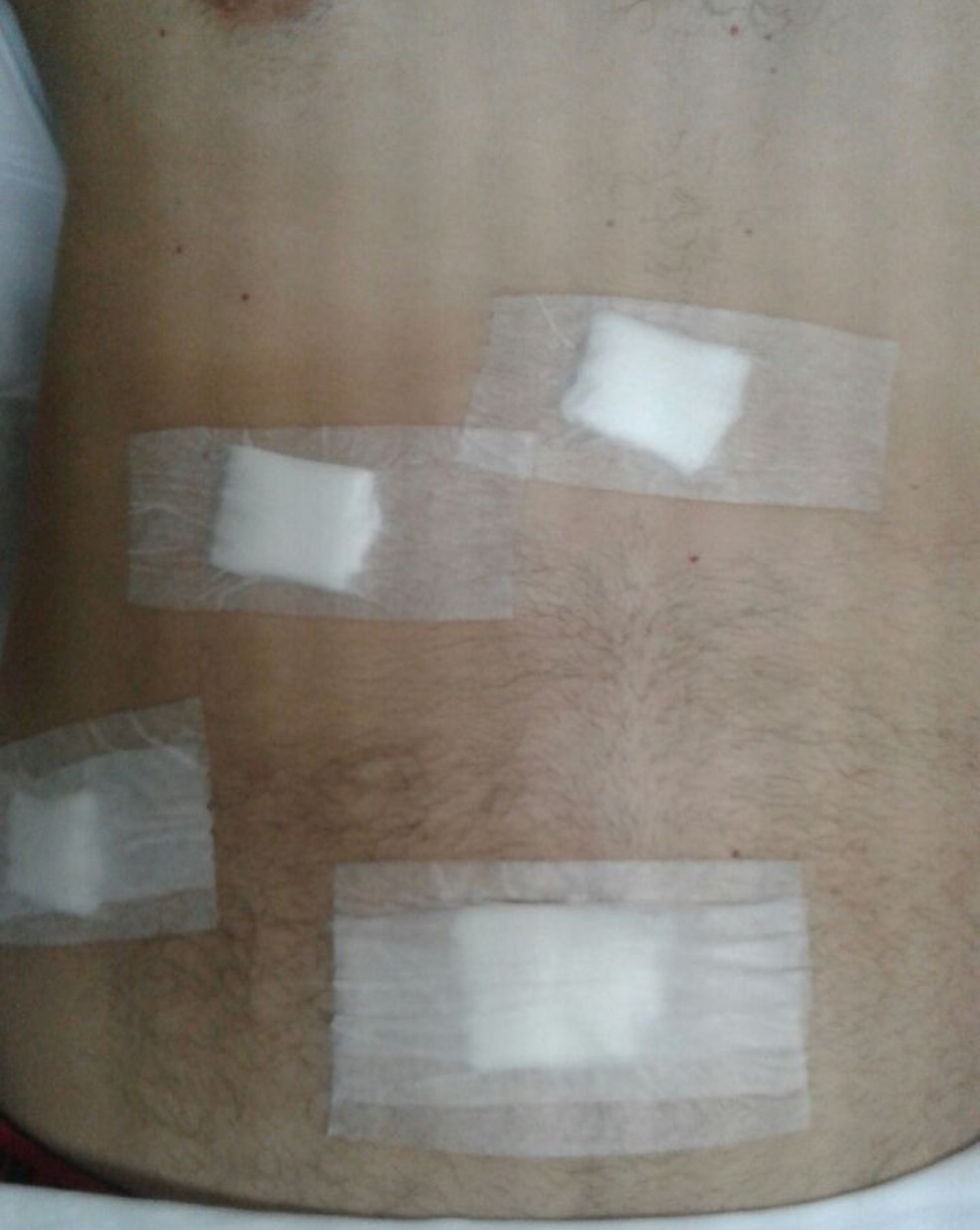 paciente com hernia sai de cirurgia em sp sem a vesicula estou indignado santos e regiao g1