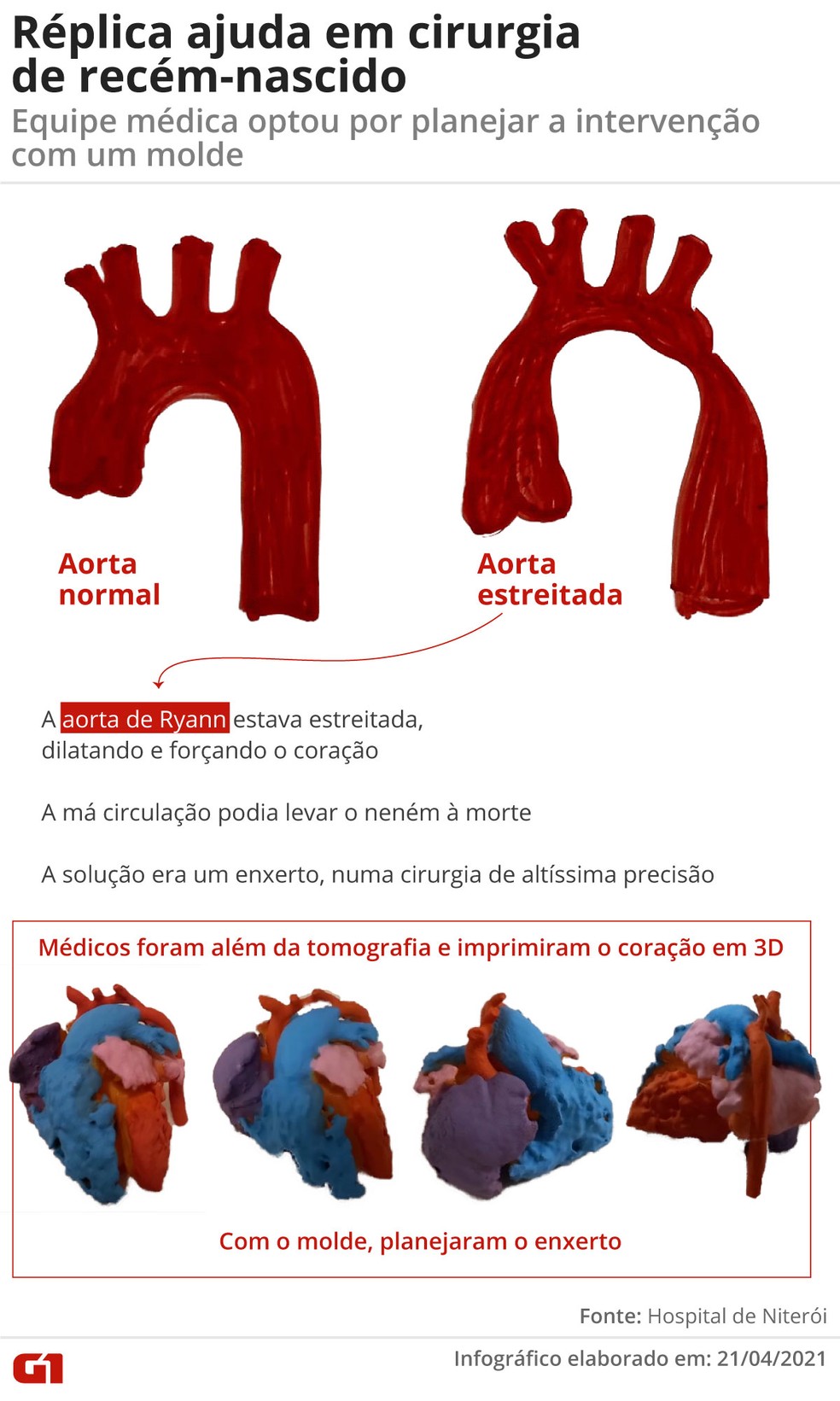 Entenda o problema do pequeno Ryann — Foto: Infografia: Guilherme Luiz Pinheiro/G1