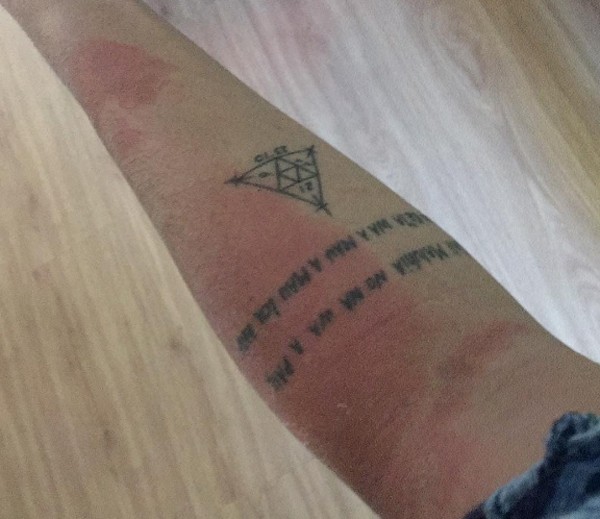 Daniele Suzuki mostra braço com queimaduras (Foto: Reprodução / Instagram)
