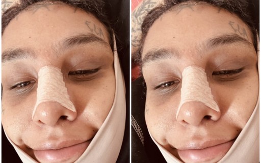 Linn da Quebrada posa com curativos após cirurgia de afirmação de gênero