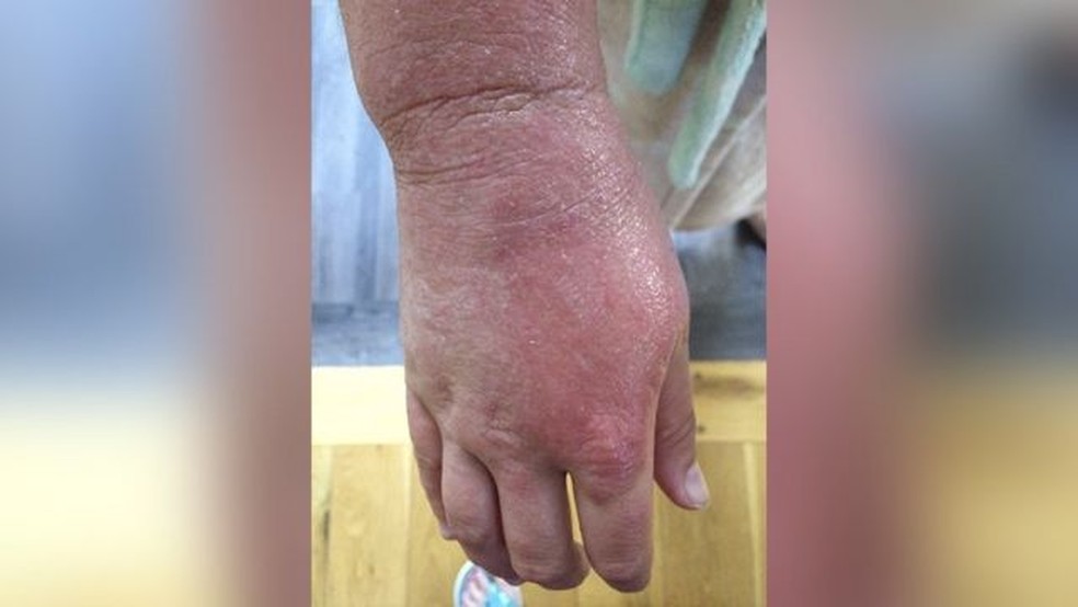 Quando o eczema surge em suas mãos, Anna diz que elas se transformam em um par de 'luvas vermelhas' — Foto: Anna Byard-Gold via BBC