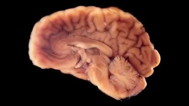 O cérebro usa até 25% do oxigênio do nosso corpo. Por isso, ele é o primeiro órgão a morrer quando paramos de respirar. (Foto: GETTY IMAGES (via BBC))
