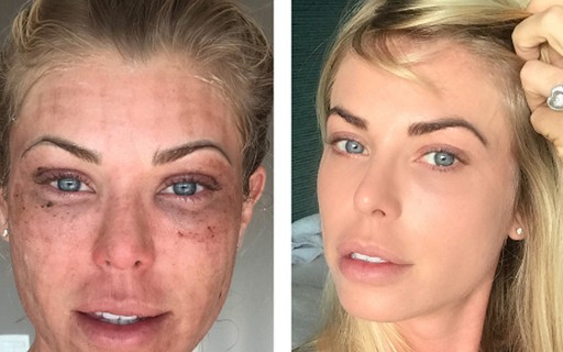Após procedimento, Carol Bittencourt posta foto com hematomas e assusta