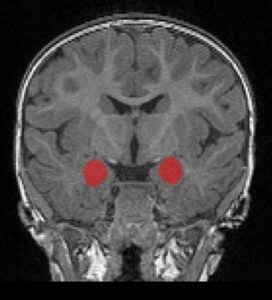 A amígdala (em vermelho) cresce muito rapidamente em bebês (6-12 meses) que mais tarde desenvolvem autismo quando crianças (Foto: CIDD/ Universidade da Carolina do Norte )