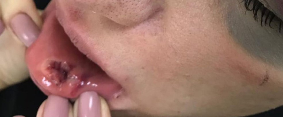 Tatiany Arci precisou levou seis pontos na boca — Foto: Arquivo Pessoal