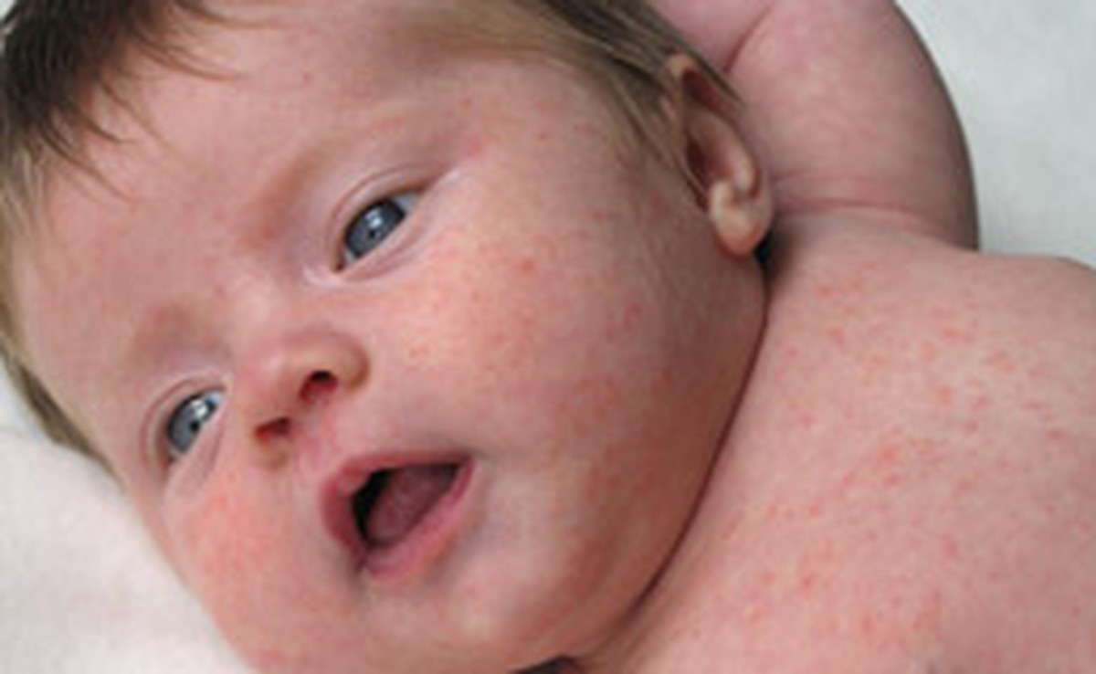 Entenda Quais Sao As Doencas De Pele Mais Comuns Em Bebes Maes E Filhos Gnt