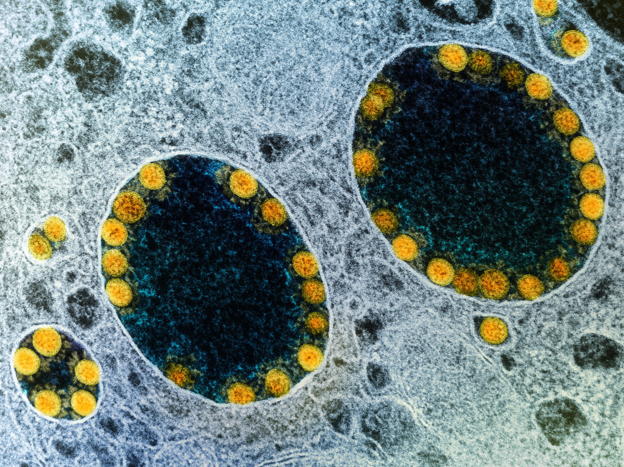 Micrografia eletrônica de transmissão de partículas do vírus Sars-CoV-2 (amarelo) dentro de endossomos de uma célula epitelial olfativa nasal fortemente infectada (Foto: NIAID)