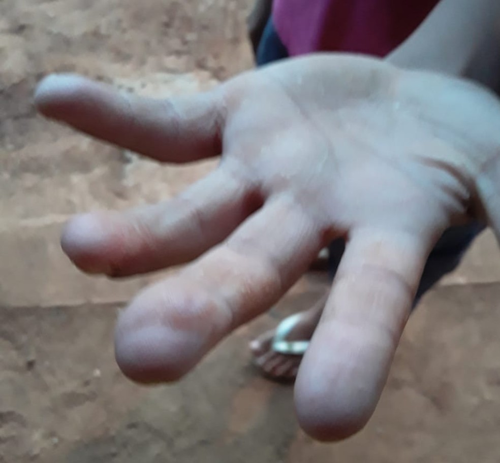 Dedos da criança foram reconstruídos em cirurgia — Foto: Arquivo pessoal