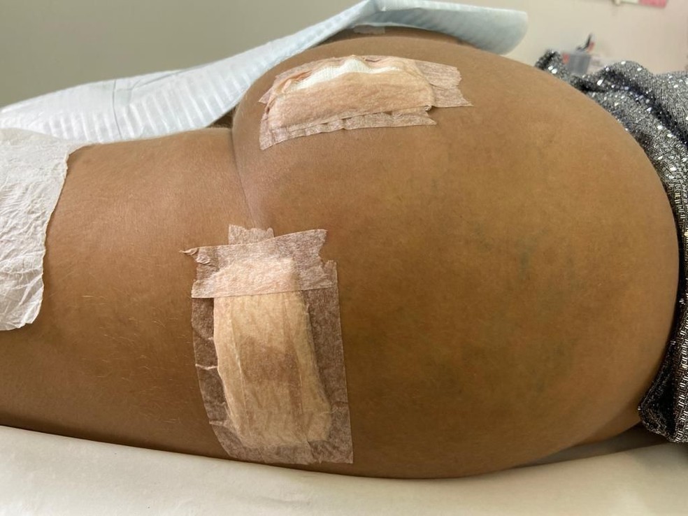 Juju Ferrari mostra curativos do novo procedimento no bumbum, para tentar corrigir os preenchimentos que deram errado — Foto: Divulgação / CO Assessoria