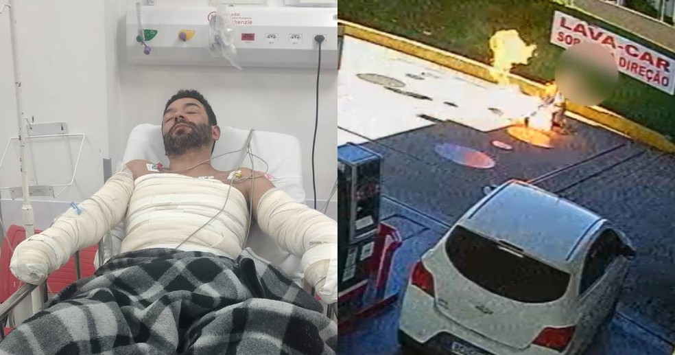 Caio Murilo teve queimaduras de primeiro, segundo e terceiro grau — Foto: RPC