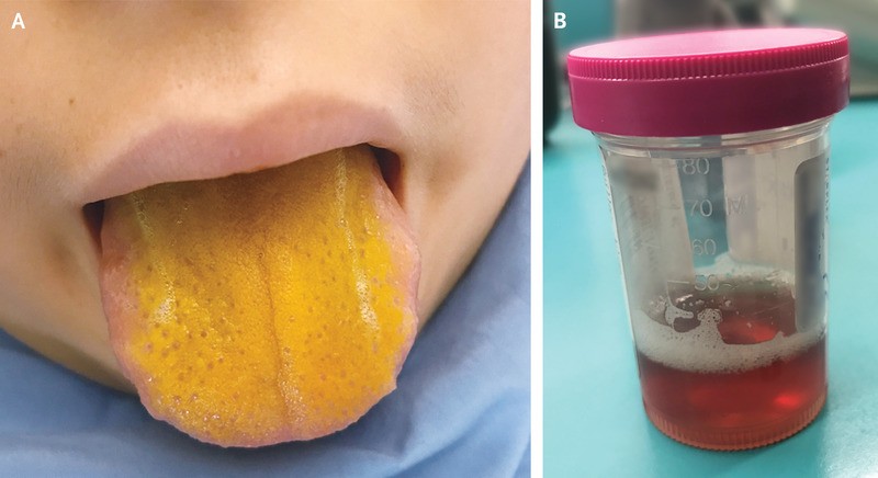 Menino estava com a língua amarela brilhante e urina escura (Foto: Reprodução/The New England Journal of Medicine)