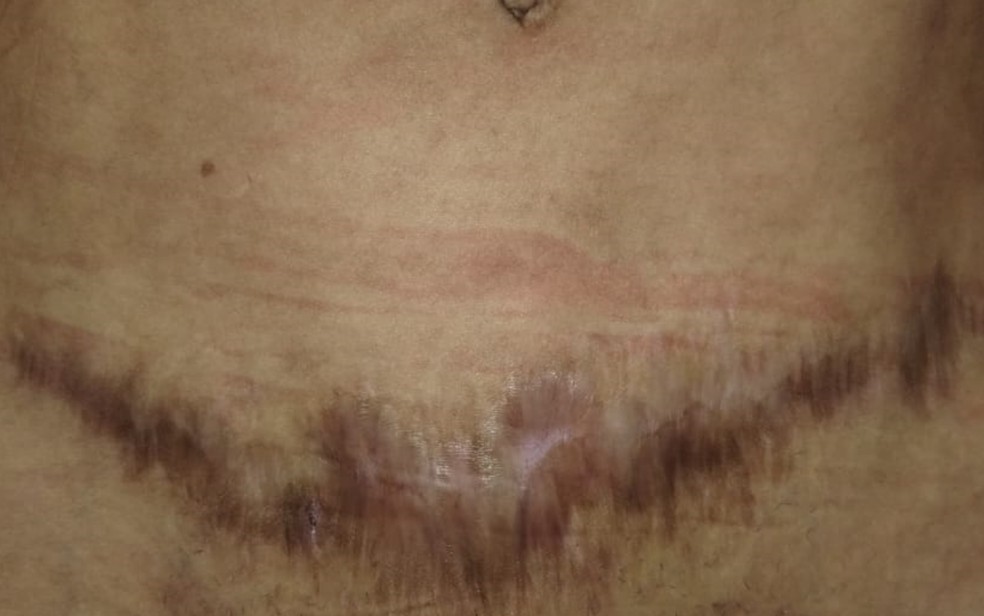 Técnica de enfermagem Joana Montel diz que ficou com cicatrizes na barriga após cirurgia em Goiânia, Goiás — Foto: Joana Monte/Arquivo pessoal