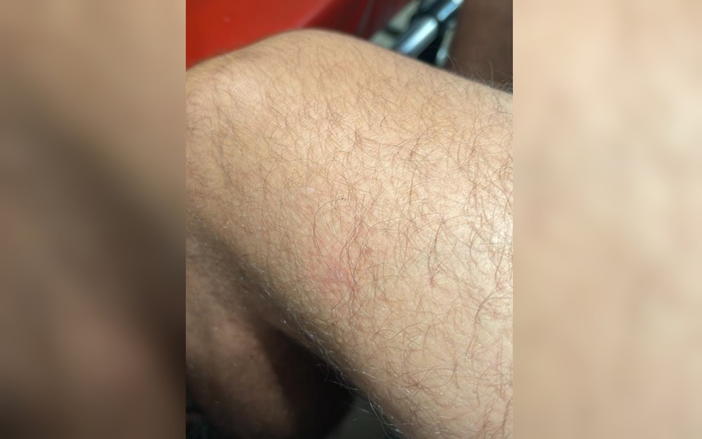 Perna de jovem picado por escorpião fica vermelha no local, em Goiânia, Goiás — Foto: Reprodução