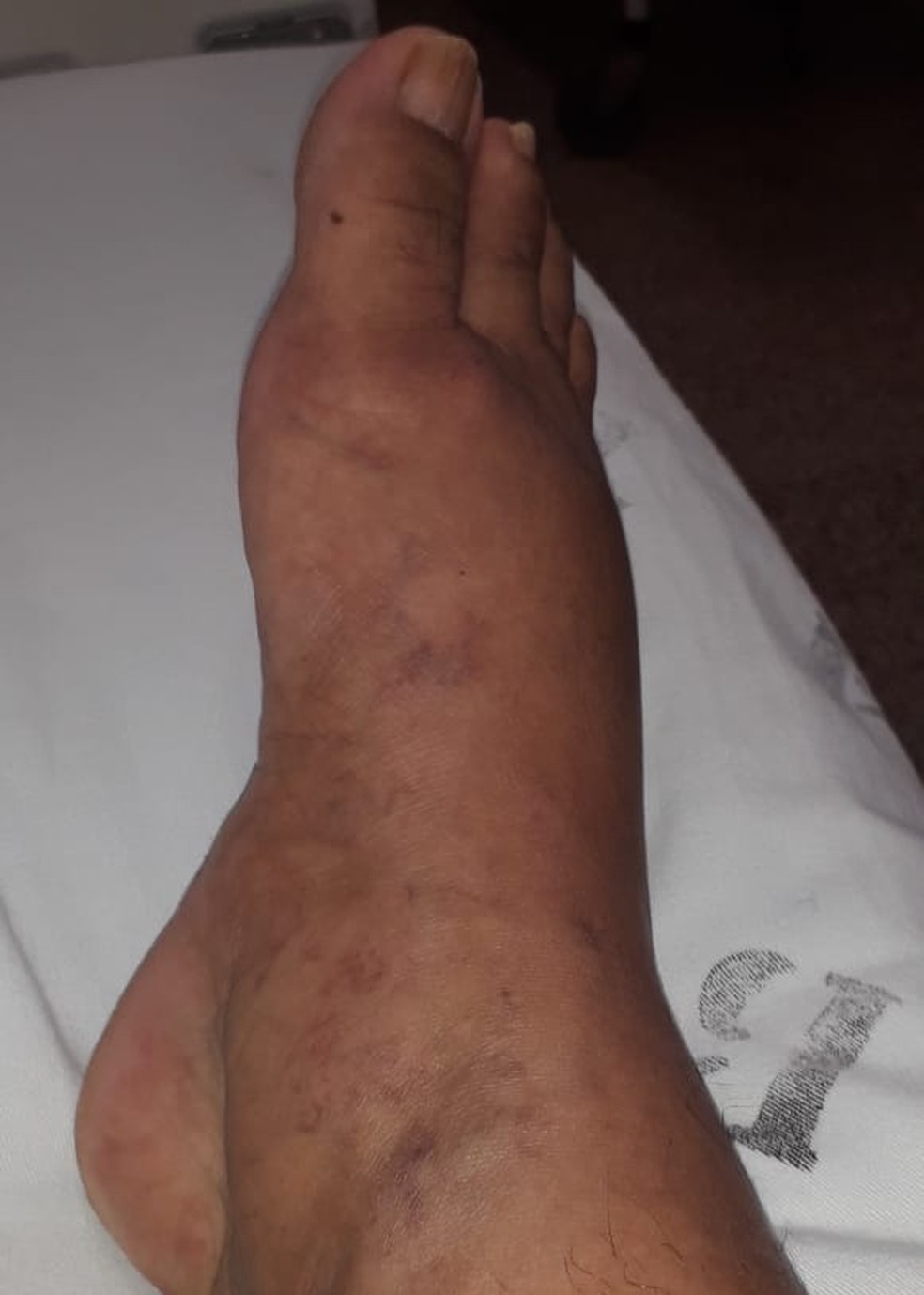 Segundo amigos, Luciene enviou a foto do pé que estava inchado após a administração de medicamento  — Foto: arquivo pessoal