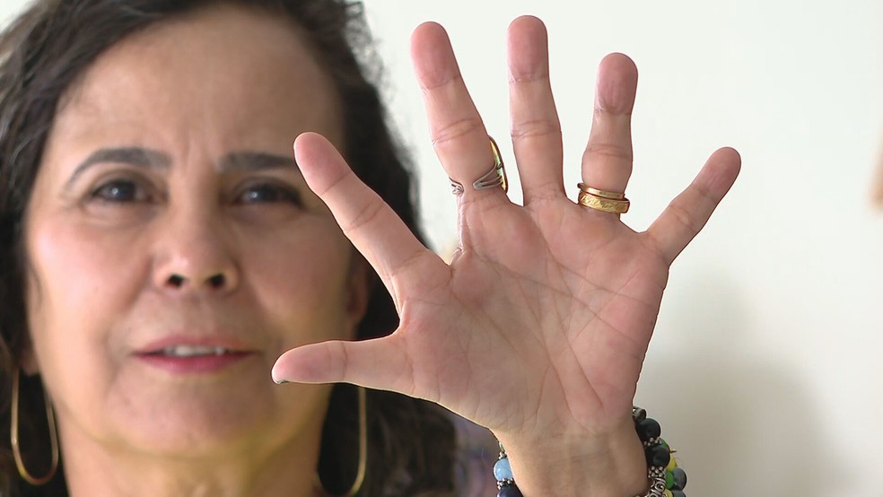 Moradora do DF tem seis dedos em cada mão — Foto: TV Globo/Reprodução