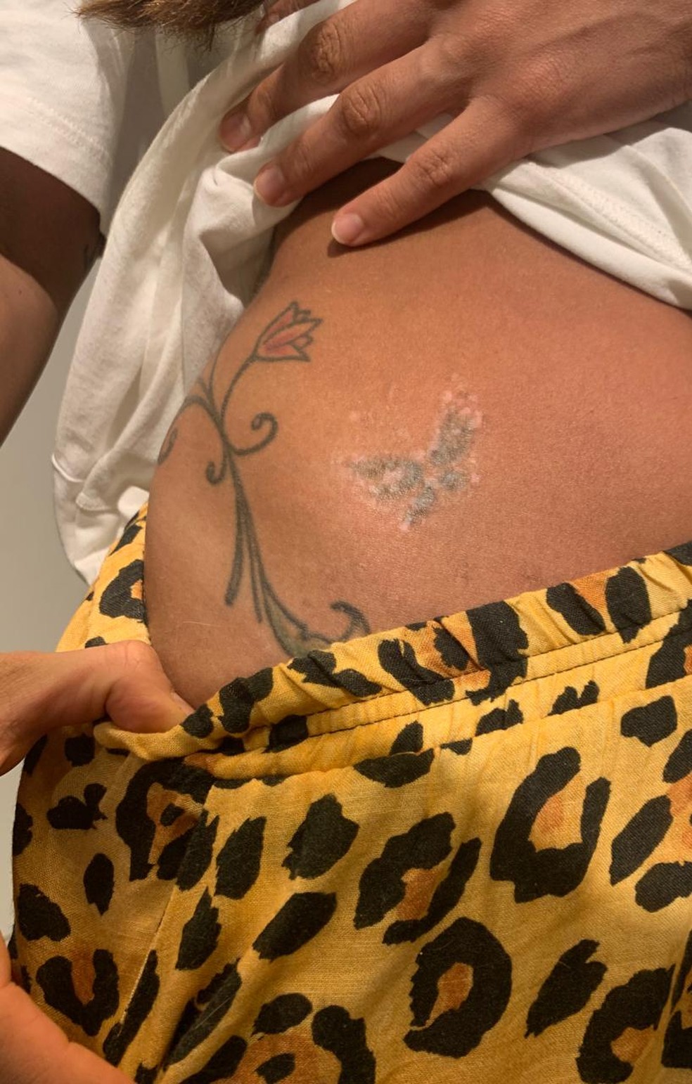 Mari, do BBB 20, está apagando tatuagem na cintura — Foto: Arquivo pessoal