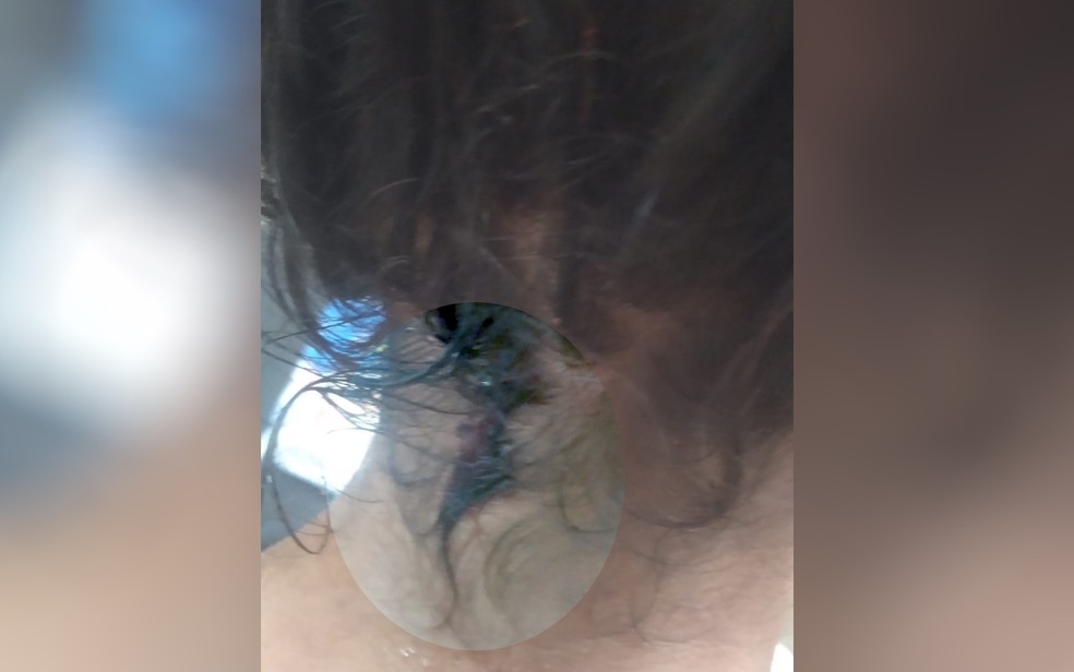 Menina precisou levar três pontos na nunca após receber facada dentro de escola, em Goiânia — Foto: Reprodução/TV Anhanguera
