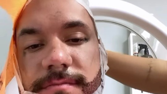Transplante de barba e cabelo: entenda como é a técnica realizada pelo ex-BBB Eliezer