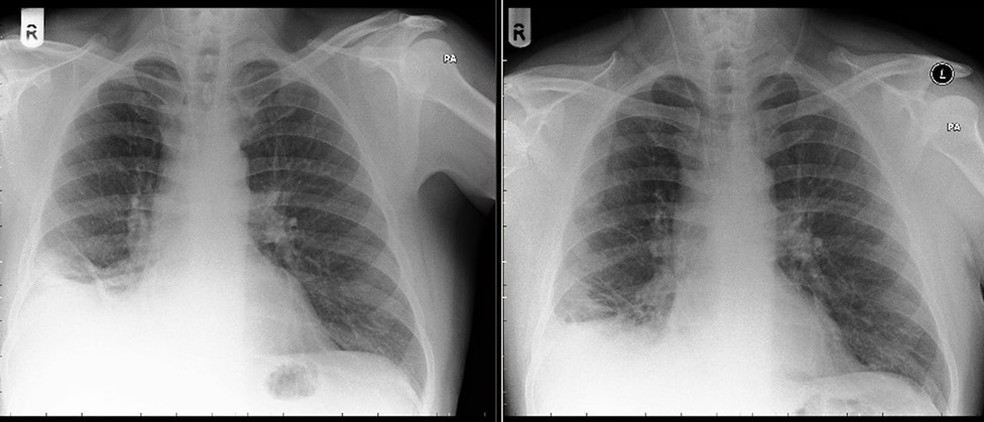 Raio-X realizado após a retirada do cone mostra melhora no pulmão do paciente  (Foto: BMJ)