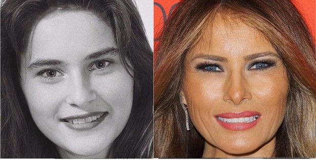 Melania Trump: antes e depois (Foto: Reprodução)