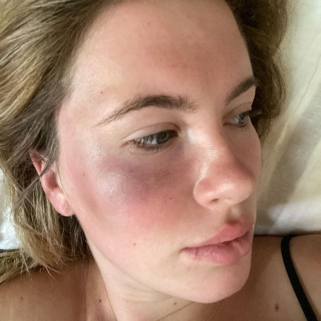 Ireland Basinger Baldwin mostra o rosto com hematomas (Foto: Reprodução/Instagram)