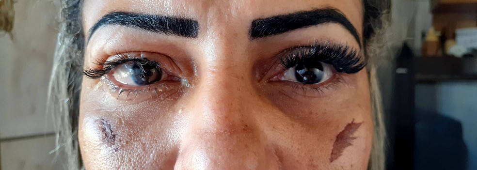 Mulher sofre lesões nos olhos depois de colocar cílios postiços em clínica de estética em Porto Velho — Foto: Facebook/divulgação
